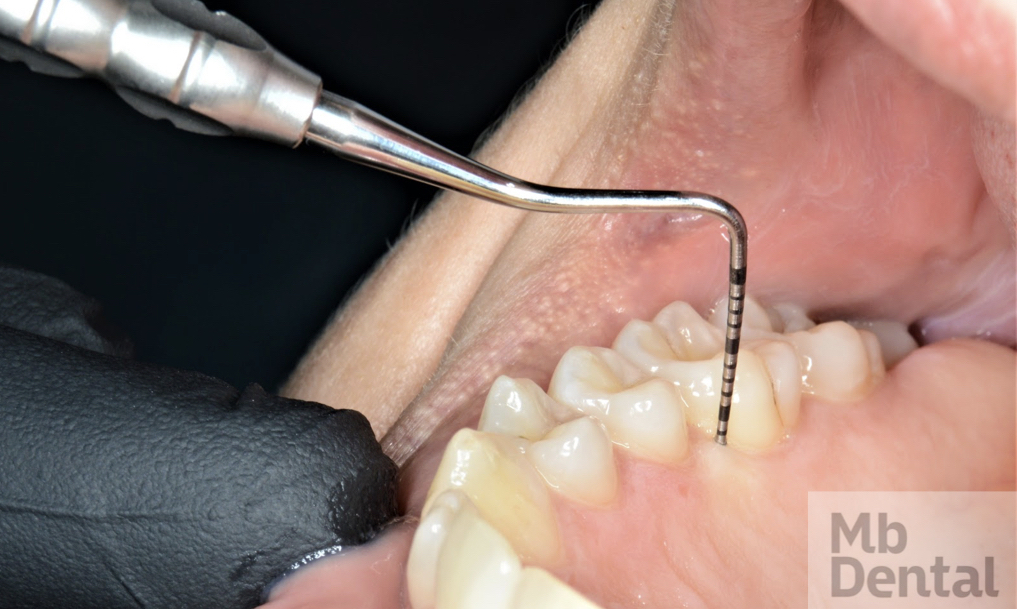 Consultatie parodontologie pentru parodontoza. Masurare pungi parodontale. Parodontometrie