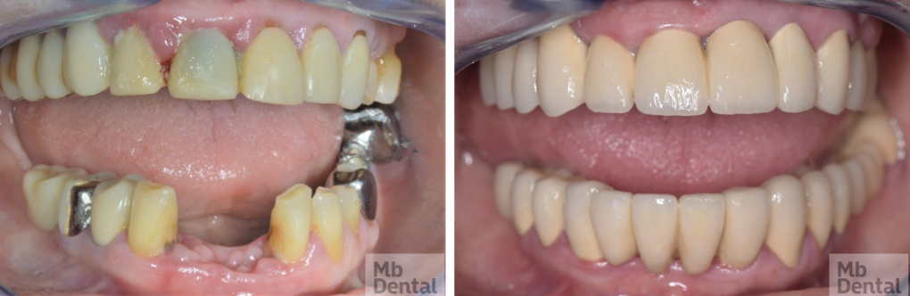 reabilitare parodontala si protetica punte ceramica pe metal. boal aparodontala. MB Dental Cluj 