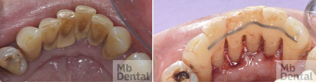 Imobilizare dinti frontali cu bibra de sticla. Terapie initiala boala pardodontala. MB Dental Cluj 