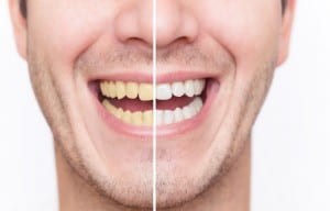 5-causes-yellow-teeth