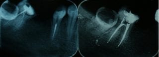 Caz-Tratament-Endodontic-microscop_3