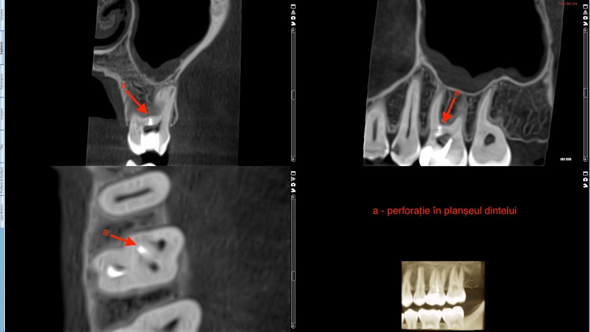Figura 1. Radiografia 3D prezentând perforația