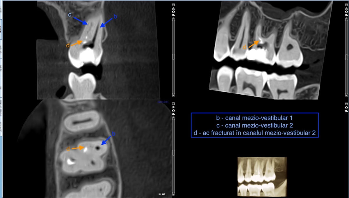 Figura 2. Radiografia 3D prezentând nivelul la care s-a fracturat instrumentul