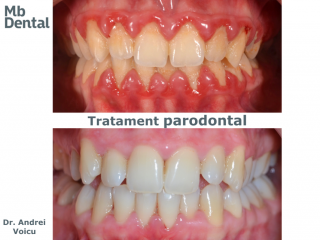 tratament parodontal