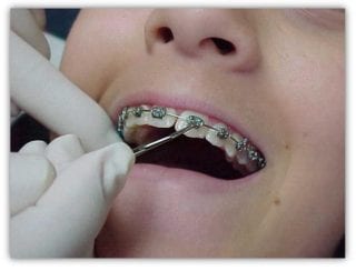 aparat-ortodontic