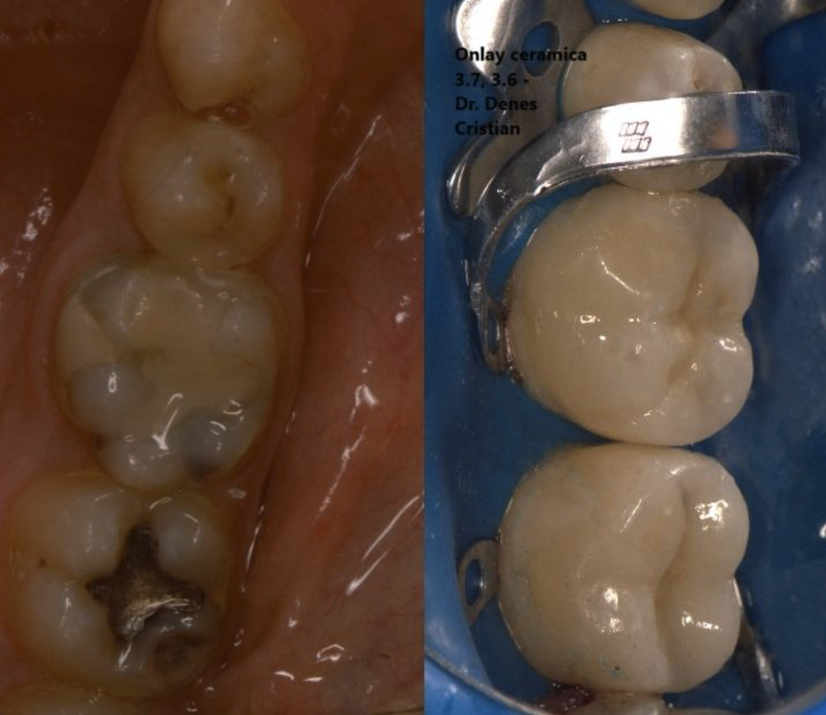 Figura 6. Aspectul înainte și după al dinților tratați prin coroane parțiale ceramice