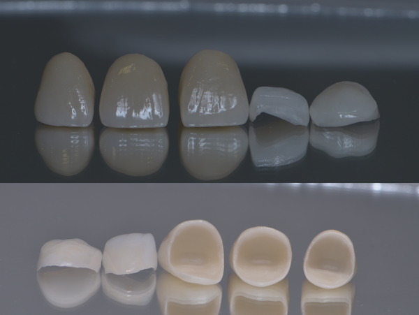 Coroană metalo-ceramică pe dinți naturali
