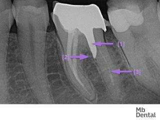 figura refacere plomba dentara la microscop