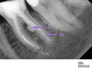 figura refacere plomba dentara la microscop