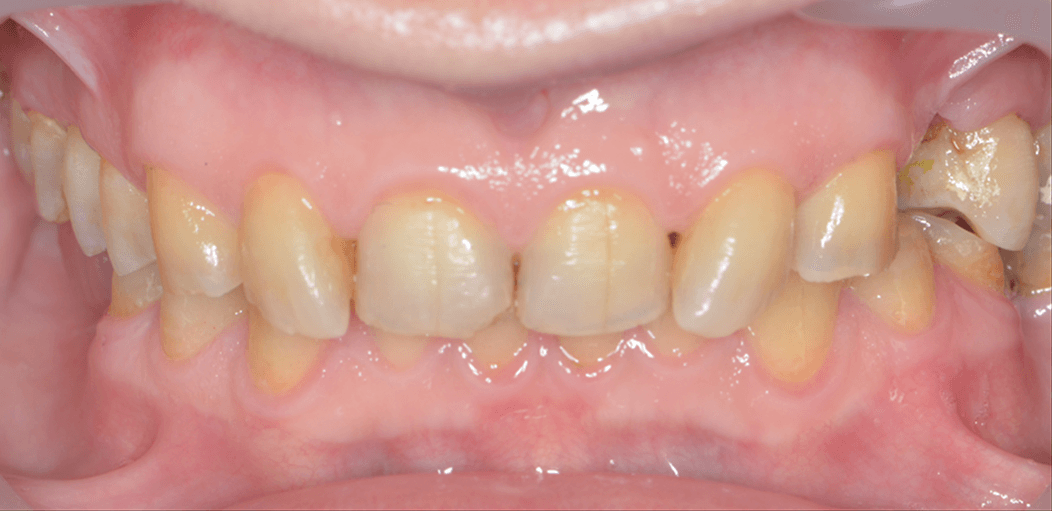 reabilitare dantura in targu mures