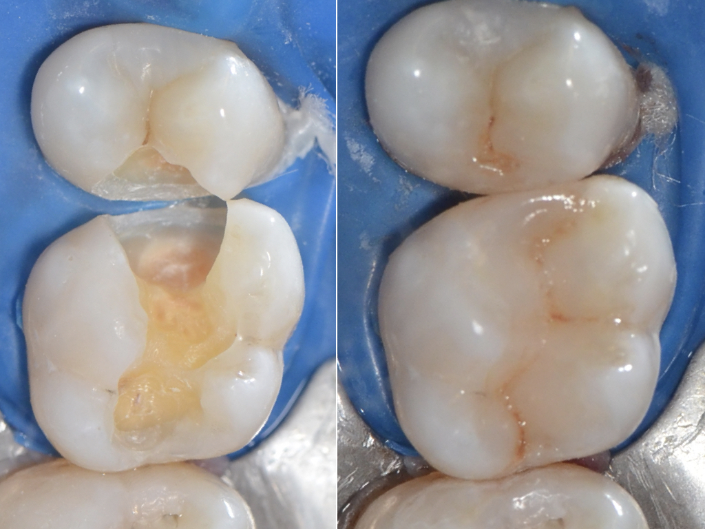 restaurare dentitie