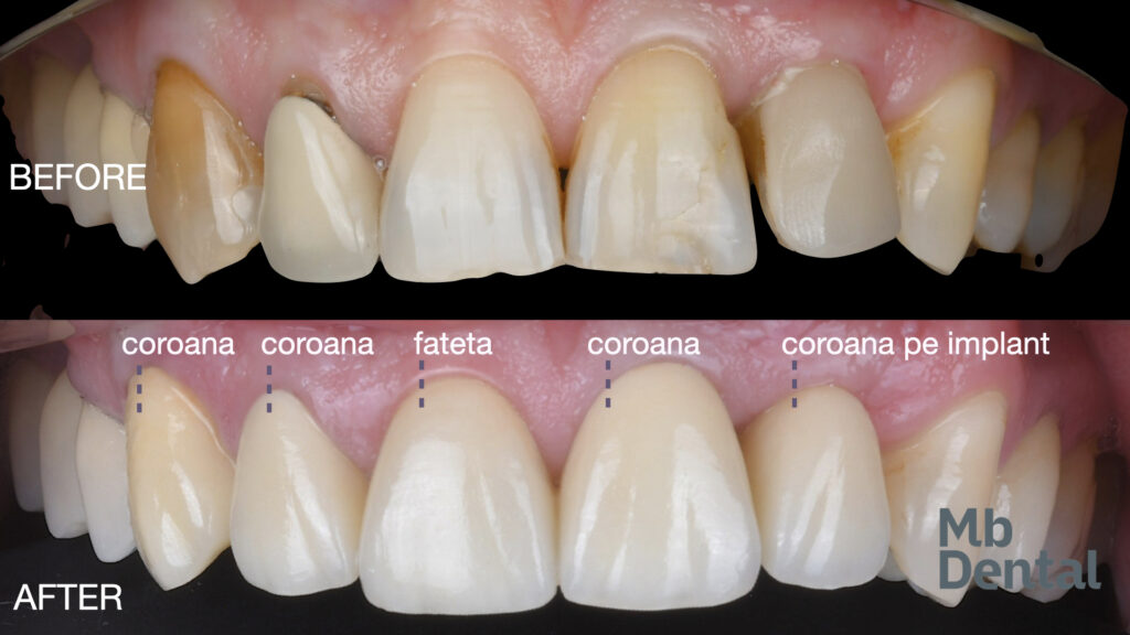 before and after