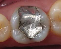 amalgam