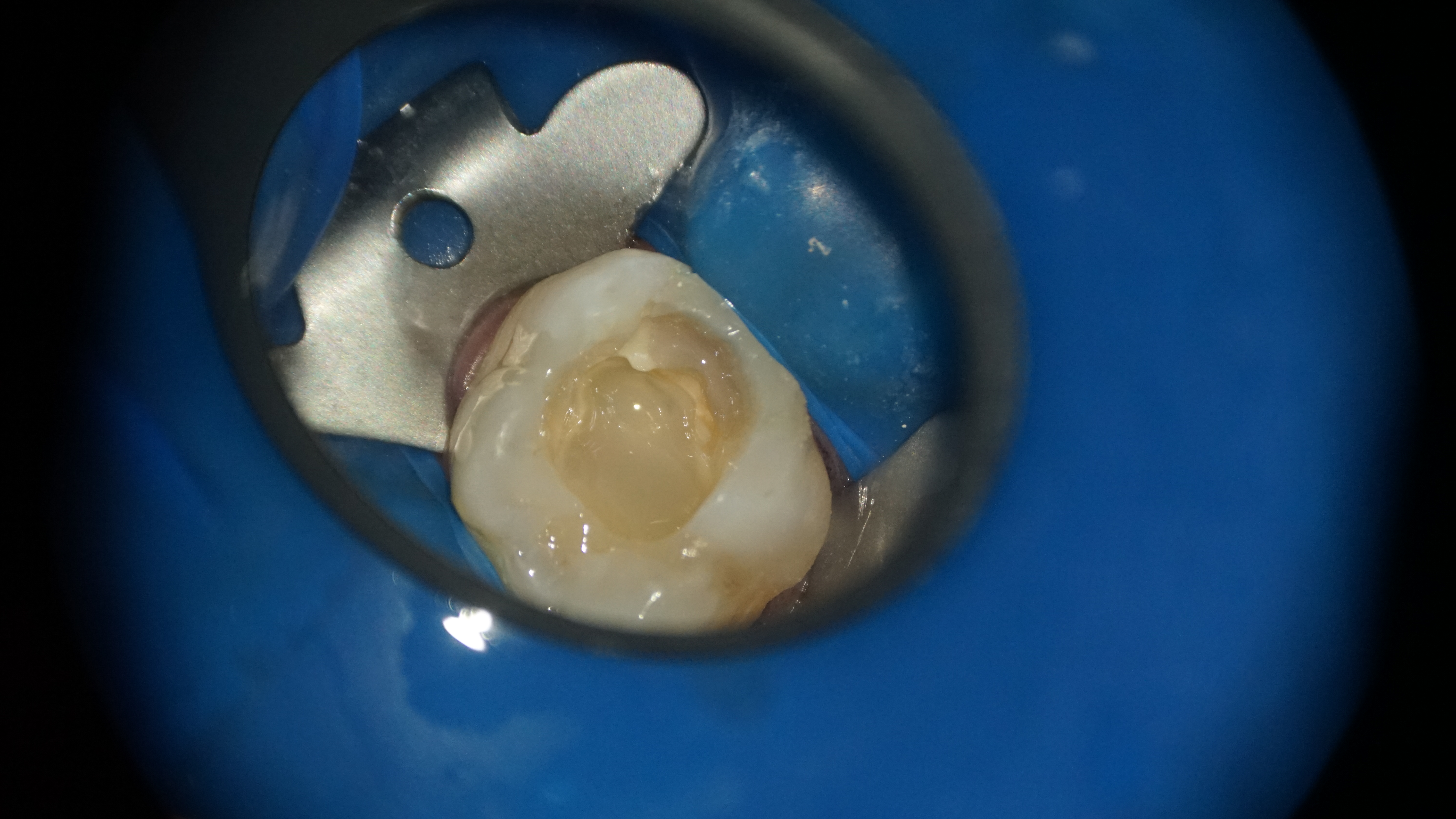 Figura 7. Sigilarea cu material compozit