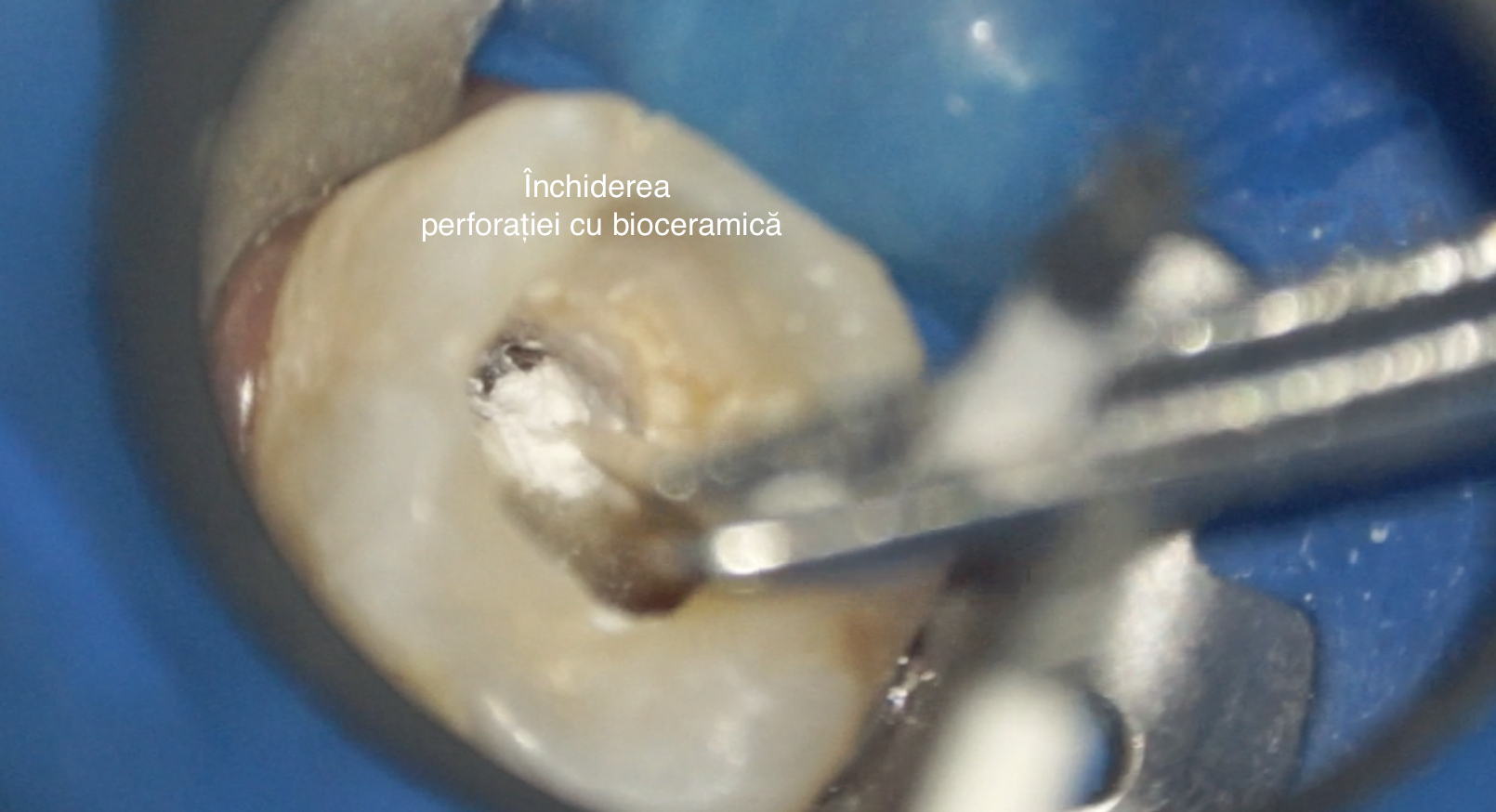 Figura 5. Închiderea perforației cu bioceramică