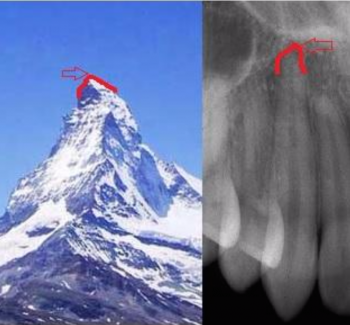 working length determination