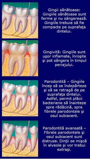 Etapele principale ale unei afectiuni parodontale