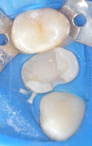 necesitatea tratamentului endodontic