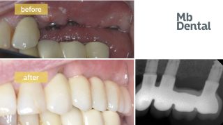 implant dentar