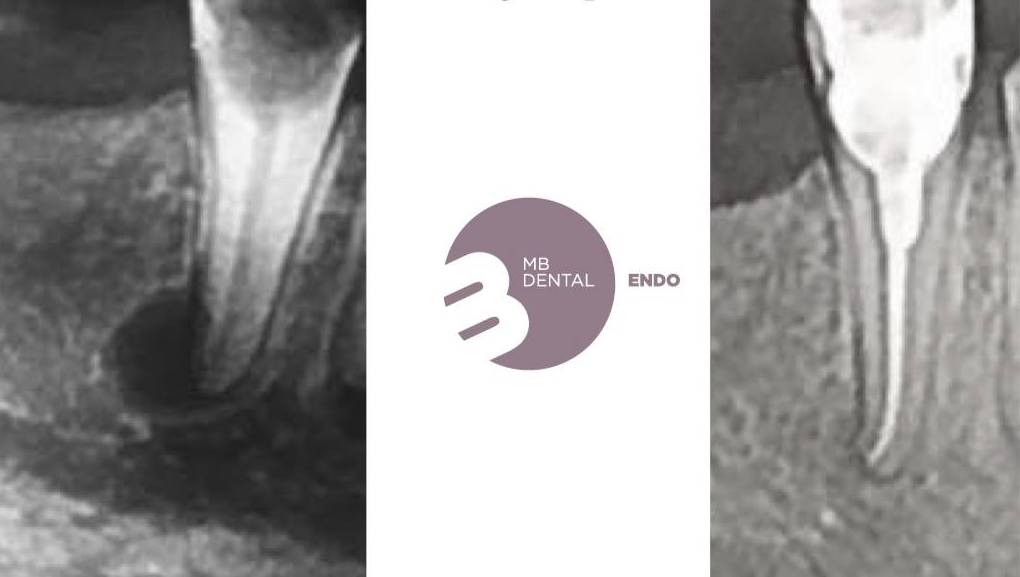 endodontie