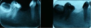 Caz-Tratament-Endodontic-microscop_1