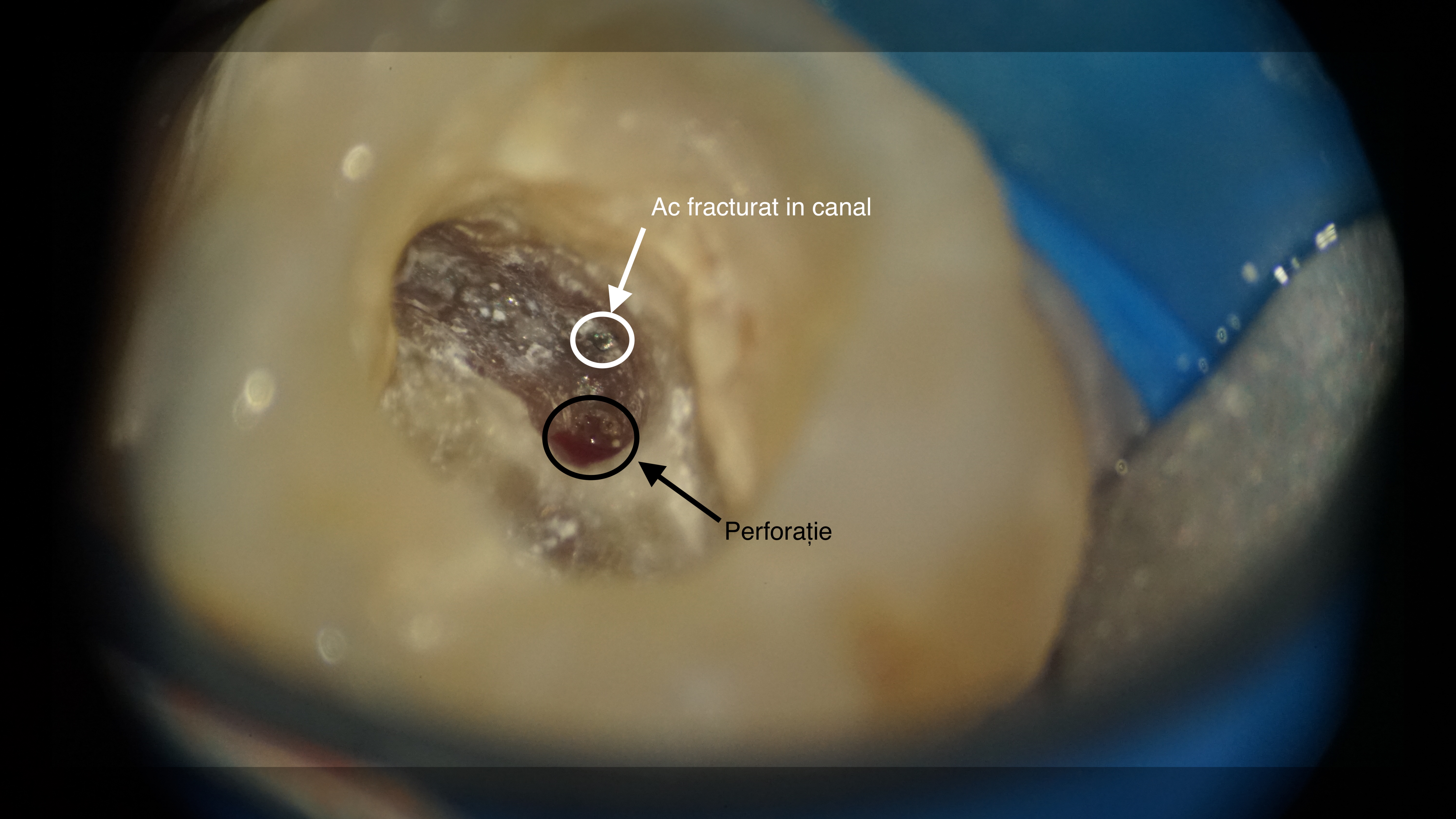 Figura 3. Închiderea perforației cu un material bioceramic și îndepărtarea fragmentului fracturat prin vibrație ultrasonică