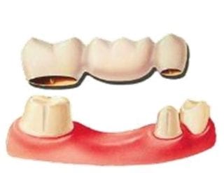 punte-dentara