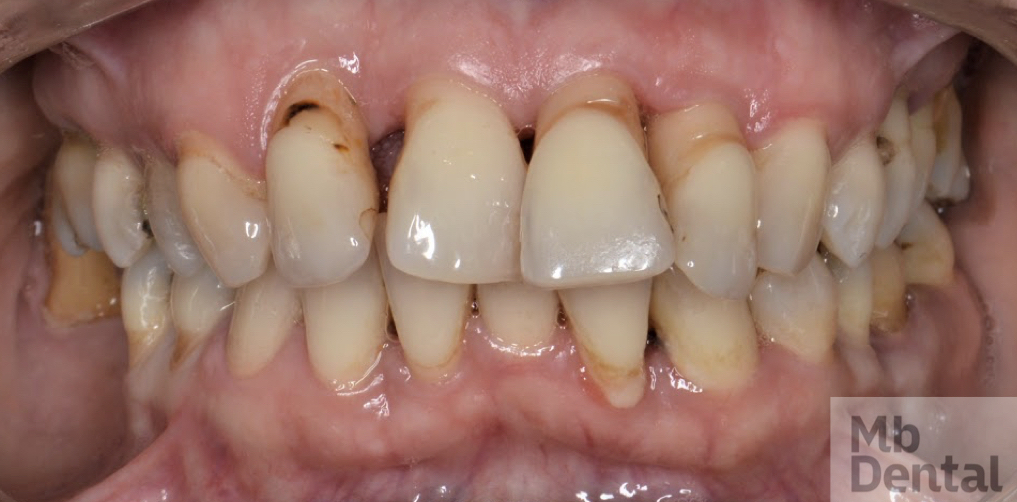 Caz sever boala parodontala