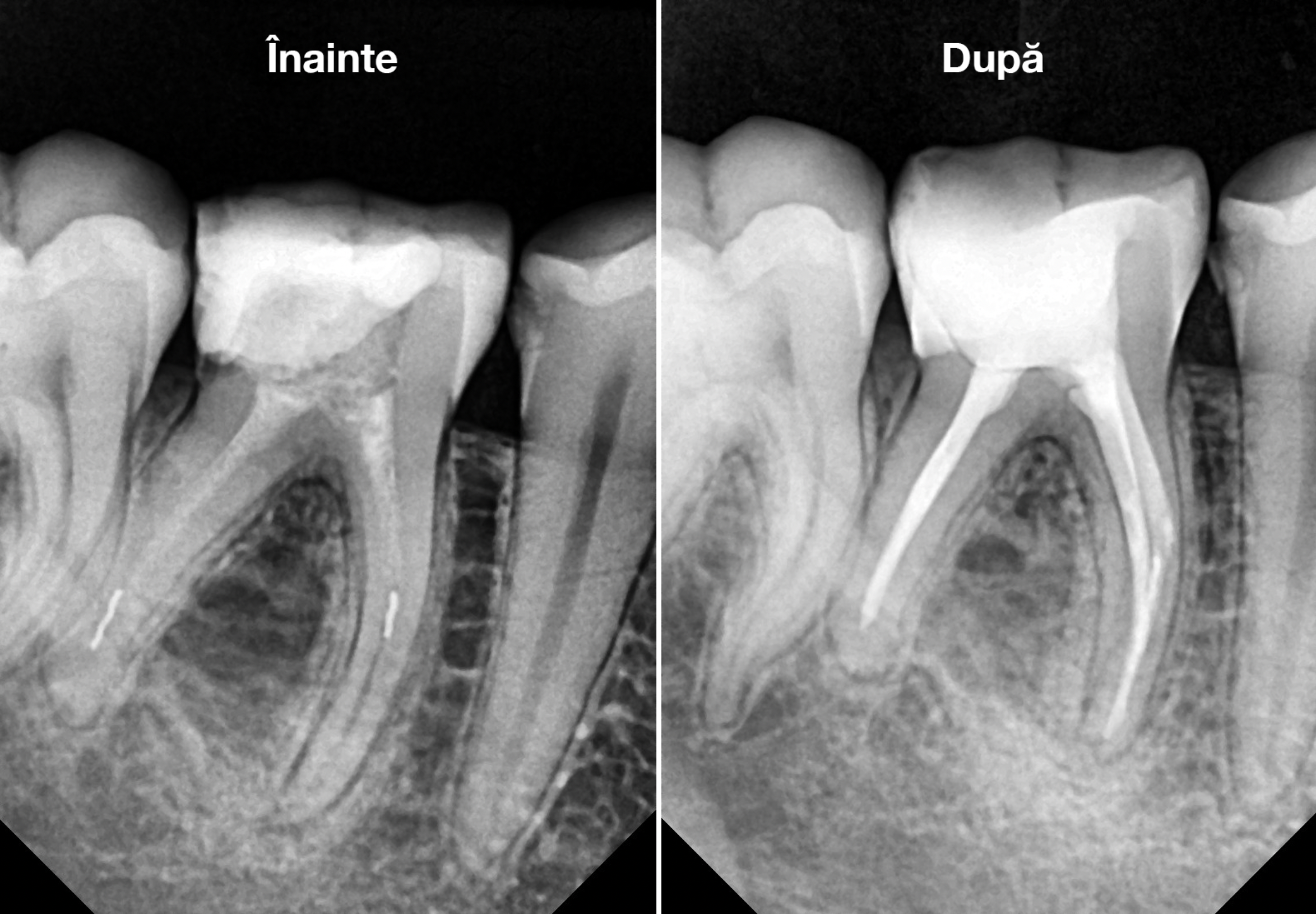 Radiografie înainte și după