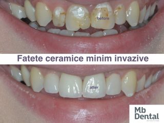 fatete dentare