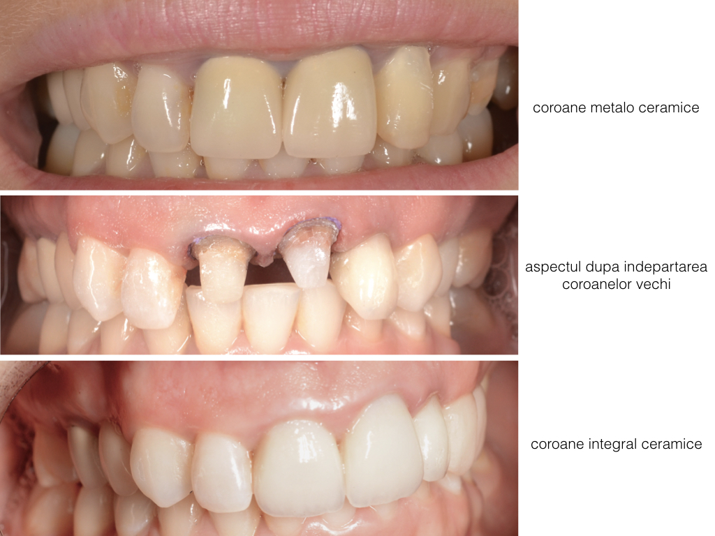 caz integral ceramica