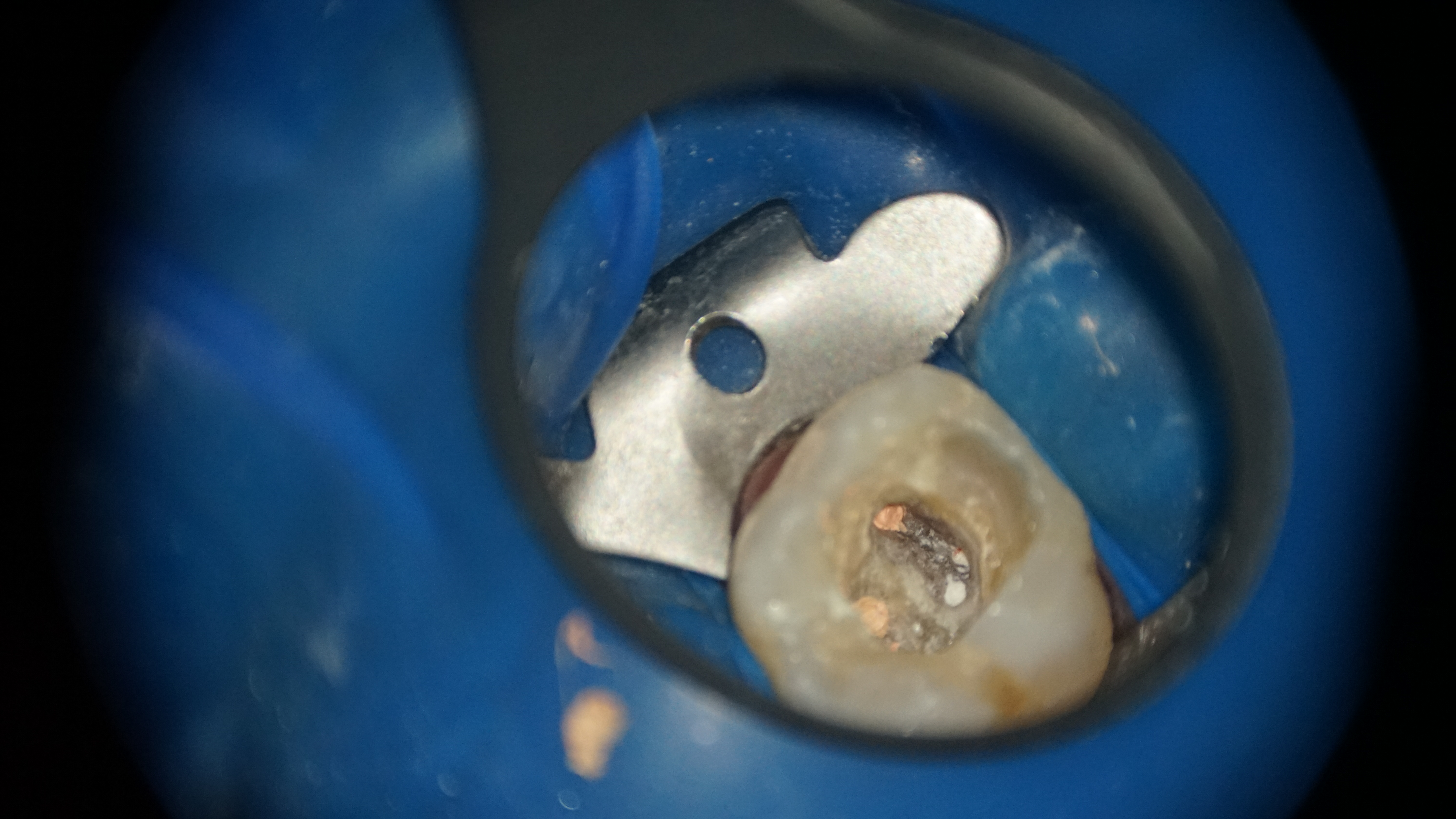 Figura 6. Obturarea finală sub control la microscop