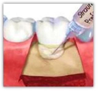 Santuri-gingivale-dezinfectare