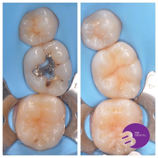 stomatologie restaurativa la microscop