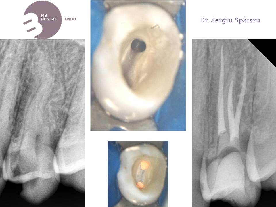 endodontie microscop