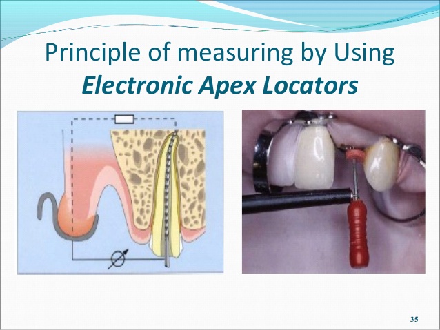 working length determination