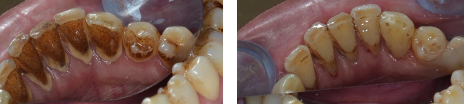 tratament parodontal