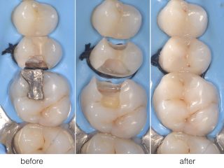 stomatologie restaurativa la microscop