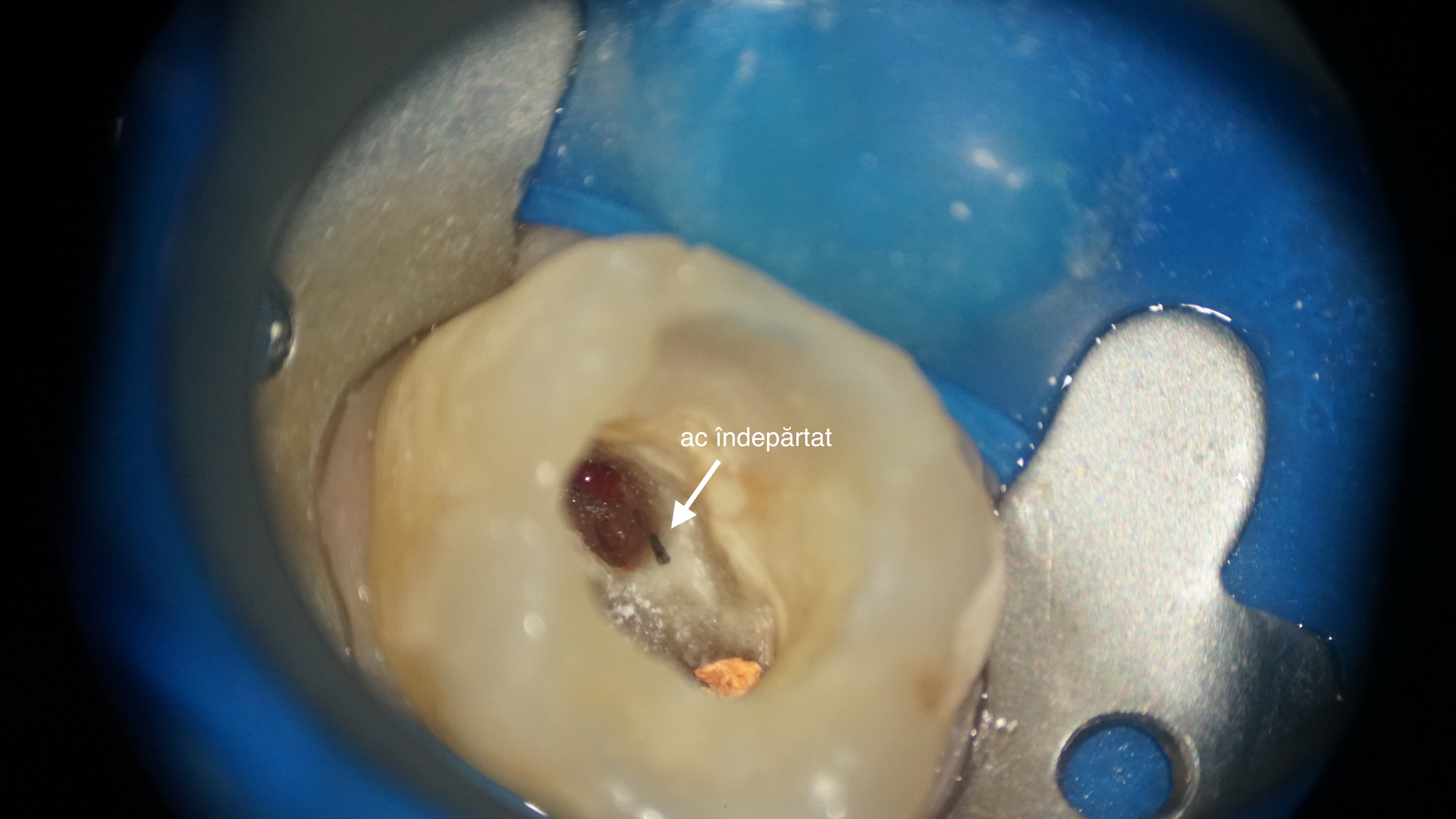 Figura 4. Asigurarea integrității structurale a dintelui și evitarea complicațiilor