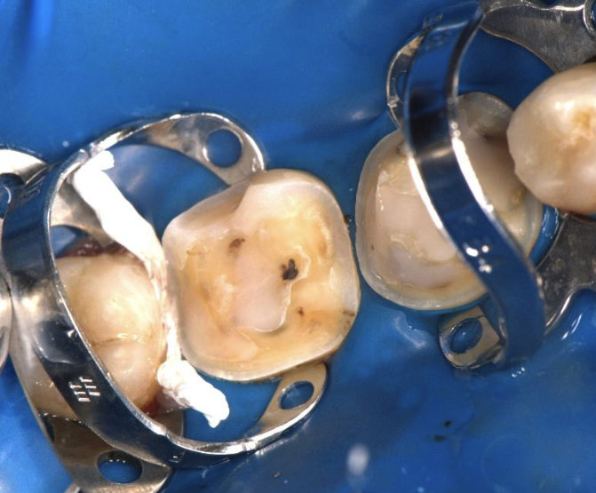 Figura 5. Aspectul final al preparațiilor înainte de cimentare