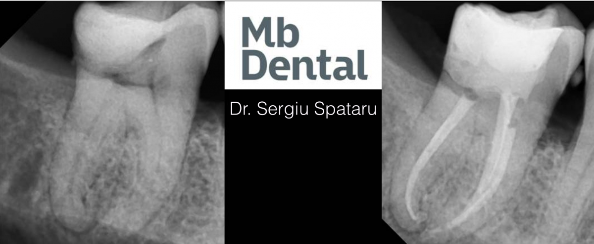 Tratamentul endodontic la microscop al dintilor cu canale curbe