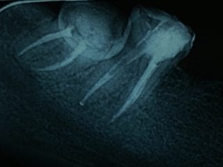 Caz-Tratament-Endodontic-microscop_4