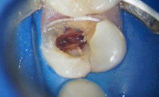 necesitatea tratamentului endodontic