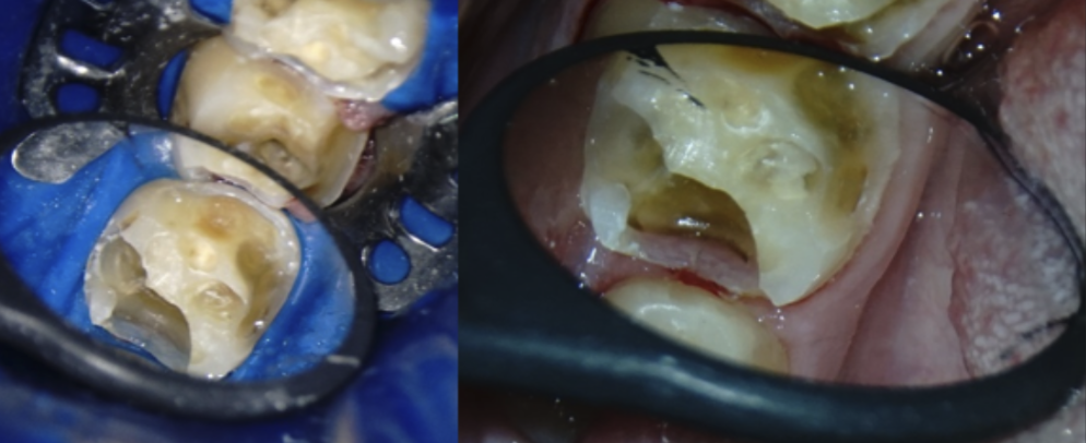 Figura 2. Dintele 3.6 după îndepărtarea cariei si a obturației anterioare