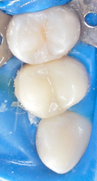 necesitatea tratamentului endodontic