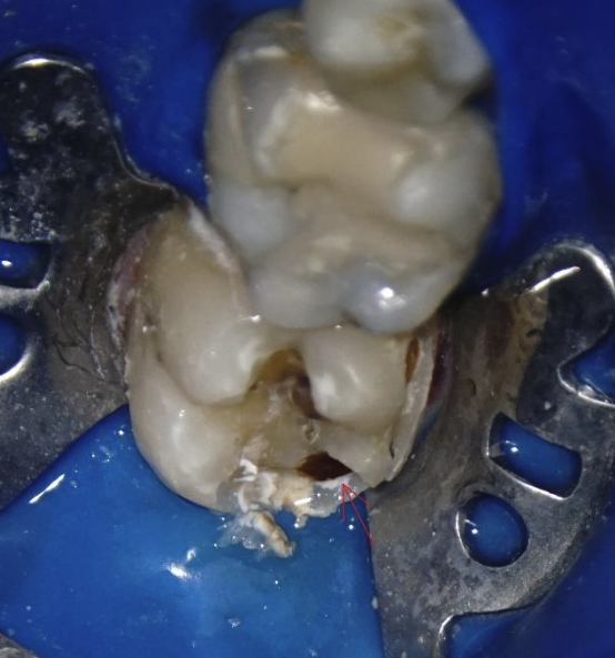 Figura 3. Prezența smalțului cretos ce poate duce la apariția ulterioară a cariei marginale