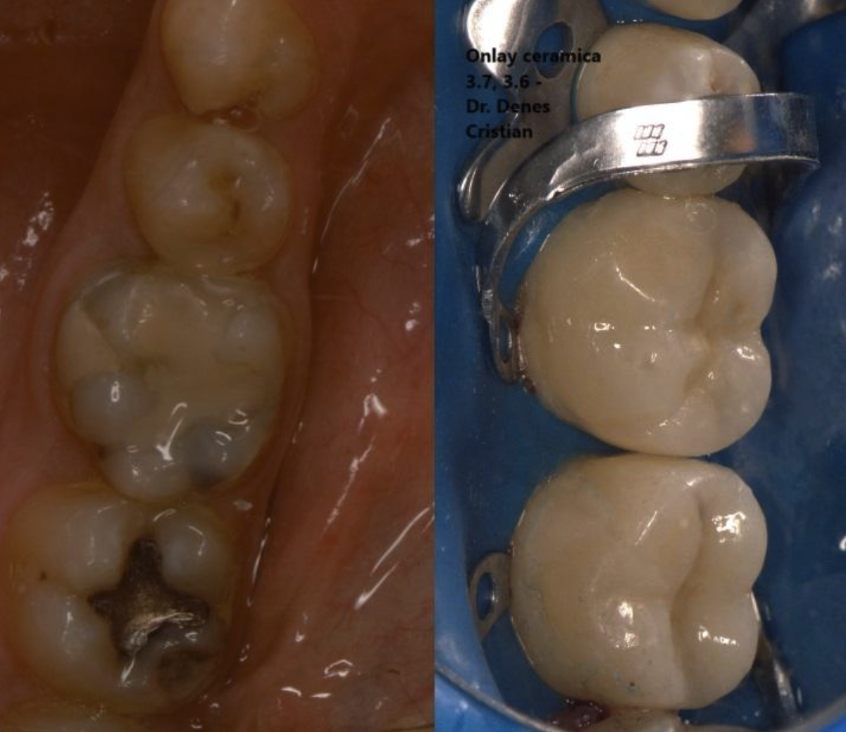 Figura 6. Aspectul înainte și după al dinților tratați prin coroane parțiale ceramice