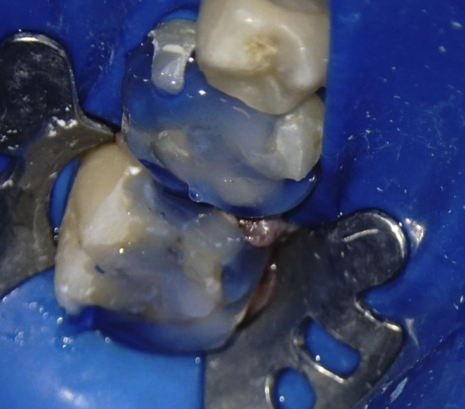 Figura 4. Aplicarea digăi lichide ca material provizoriu