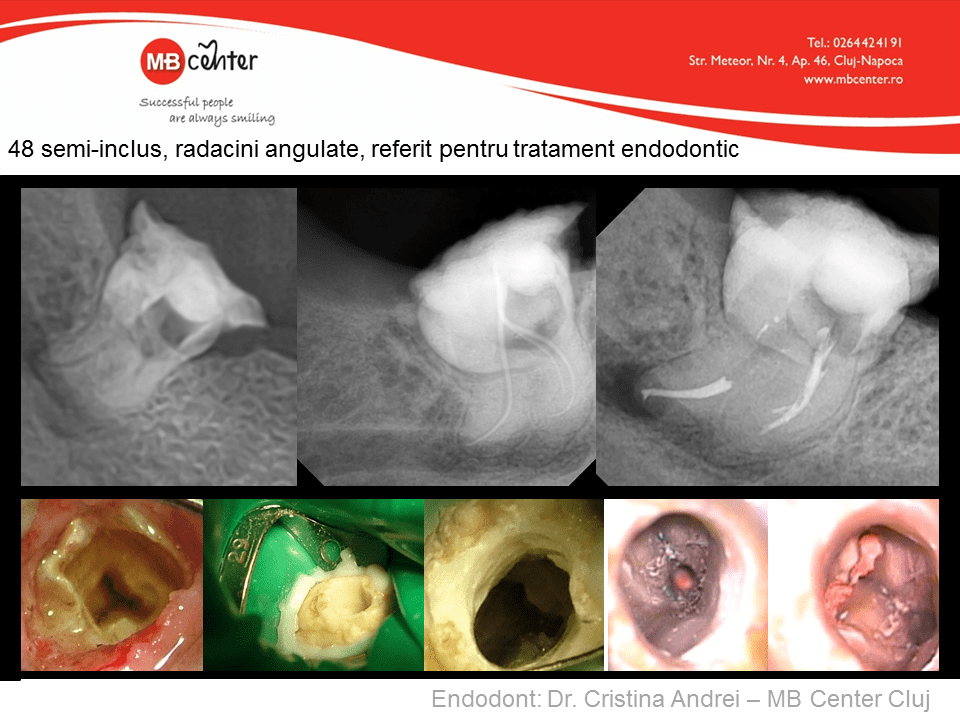 https://v2.mbdental.ro///wp-content/uploads/2016/07/Tratamanet-endodontic.png